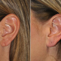 Ear Lobe Repair