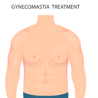Gynecomastia treatment